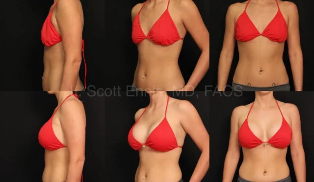 Breast Augmentation Achieve Beautiful Results with Motiva  Wealth Health  Tech  Your Guide to Success Breast Augmentation Achieve Beautiful Results with Motiva