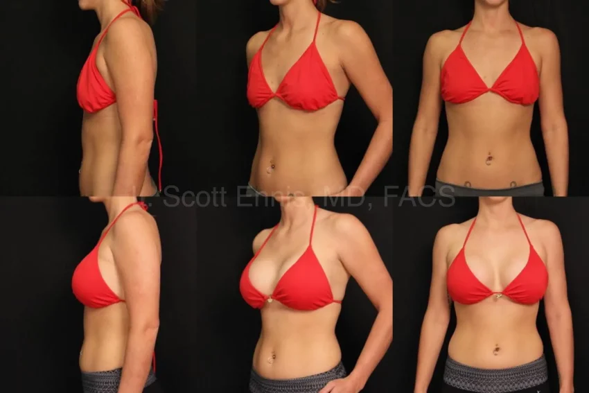 Breast Augmentation: Achieve Beautiful Results with Motiva