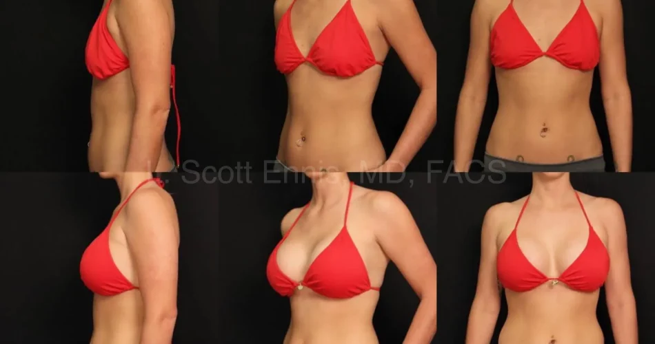 Breast Augmentation: Achieve Beautiful Results with Motiva