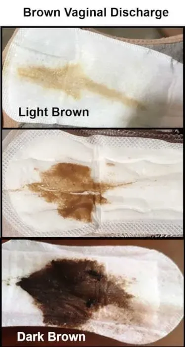Brown Discharge: Causes, Symptoms, and What to Know